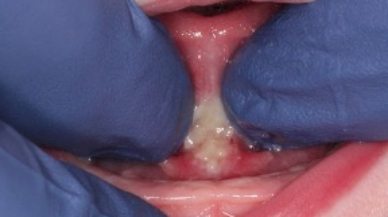Image of Tongue-Tie patient one week after treatment