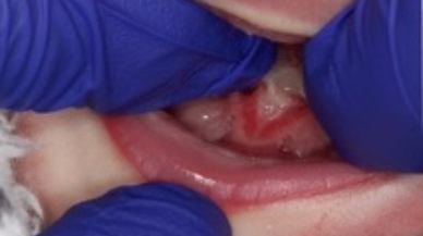 Image of Tongue-Tie patient one week after procedure