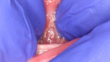 Image of Tongue-Tie patient after frenectomy
