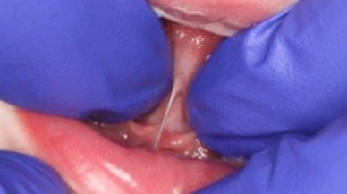Image of Tongue-Tie patient before frenectomy