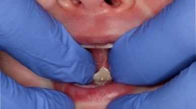 Image of Tongue-Tie patient one week after frenectomy