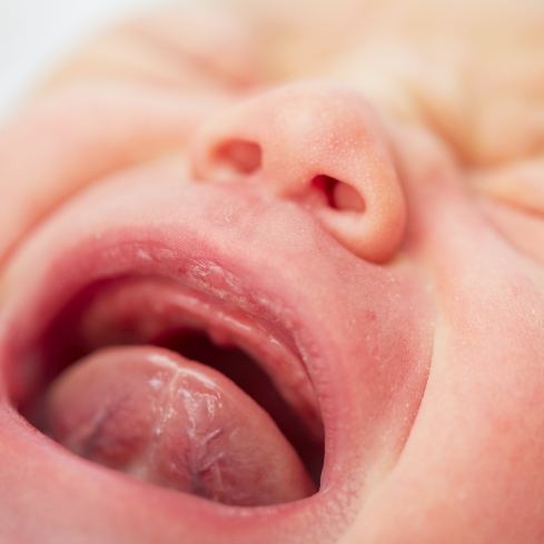 Closeup of crying infant with Tongue-Tie